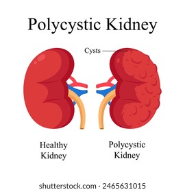 Human Polycystic Kidney Diagram Vektorgrafik