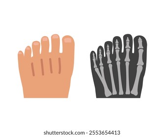 Human polydactyly. 6 toe external and internal view on x-ray. Medical chart.