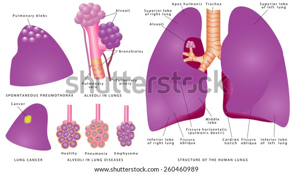 Human pulmonary system. Anatomy of the\
human lungs. Detailed diagram of the human lungs. Alveoli in lungs.\
Alveoli Changes in Lung Diseases. Lung  Cancer. Pulmonary blebs are\
a cause of\
pneumothorax\
