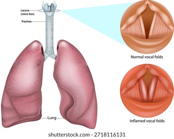 Sistema respiratorio humano con laringe, tráquea y pulmones. Pliegues vocales normales e inflamados. Diferencias anatómicas entre las cuerdas vocales sanas y la inflamación asociada con laringitis, trastornos de la voz e irritación de las vías respiratorias. 