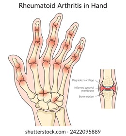 Human Rheumatoid arthritis of hand structure diagram hand drawn schematic vector illustration. Medical science educational illustration