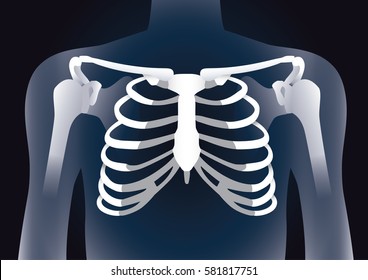 Human rib cage in X-ray image concept. Illustration about damage inside body.