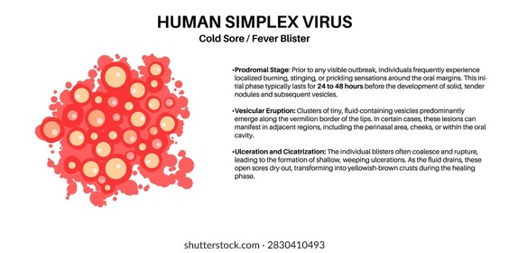Human simplex virus HSV1 cold sore fever blister clinical development stages medical infographic vector illustration with detailed text description of prodromal, vesicular eruption, and ulceration.