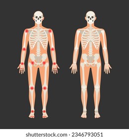 Human skeleton with pain points in rheumatoid arthritis. Men anatomy illustration with a body silhouette. Vector isolated flat of skull and bones in body. Skeleton with injury from arthritis