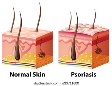 Human Skin Diagram With Normal And Psoriasis Illustration