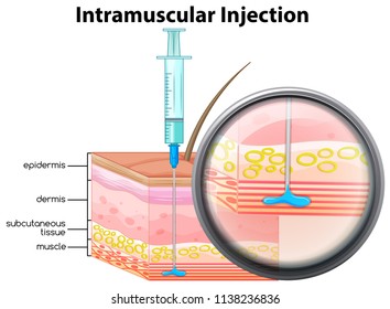 Human Skin Intramuscular Injection Illustration