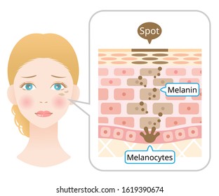 Human Skin Layer With Facial Spot Anatomy. Diagram Of Melanin And Melanocytes In Human Skin. Beauty And Skin Care Concept