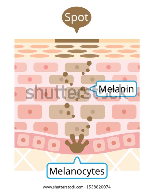 メラニンと黒い斑点の皮膚の層 インフォグラフィックのスキンレイヤーイラスト 美容 肌のケアのコンセプト のベクター画像素材 ロイヤリティフリー