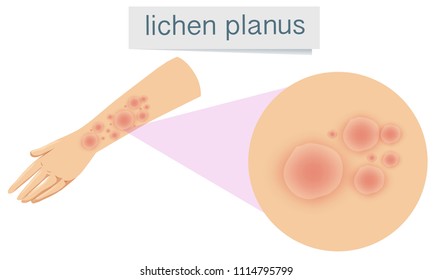 Human Skin with Lichen Planus illustration