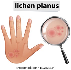 A Human Skin Problem Lichen Planus illustration