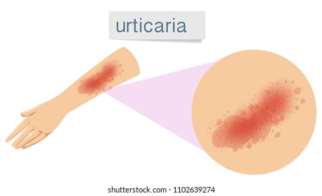 A Human Skin Problem Urticaria Illustration