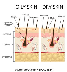 Human Skin Types And Conditions. Dry And Oily. A Diagrammatic Sectional View Of The Skin.