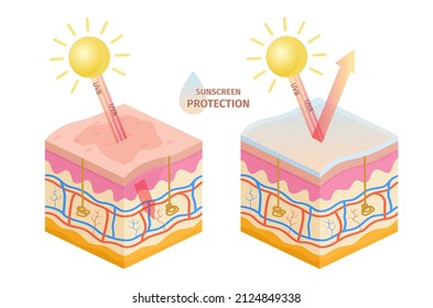 Human skin uv rays protection, before and after sunscreen. Sun uva, uvb epidermis damage prevention lotion. Skin sunburn vector infographic. Illustration of sunburn and sunblock ultraviolet