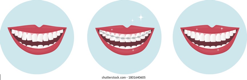 Human smile with wide open white and straight teeth with brackets. Dental service - Orthodontic treatment and straightening of teeth. Example of the mouth before and after alignment. vector 