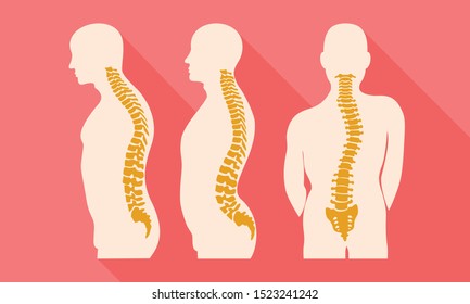 4,357 Scoliosis spine Stock Illustrations, Images & Vectors | Shutterstock