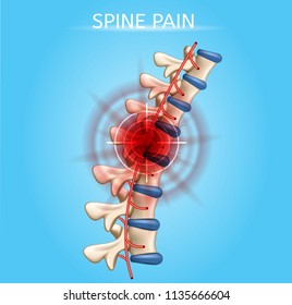 Human Spine Pain Realistic Vector Medical Scheme with Sight Cross on Pain Epicenter in Damaged Vertebra of Spinal Column Illustration. Human Musculoskeletal System Painful Diseases, Joint Injuries