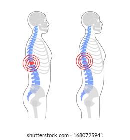 Human spine pain and skeleton vector illustration. Back bone and vertebral column injury. Symbol of spinal surgery, rehabilitation, artritis. Medical, educational and science banner 
