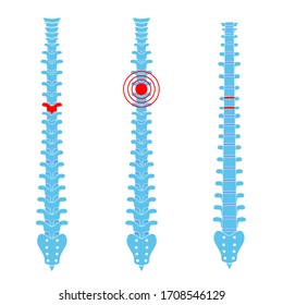 Human spine pain vector illustration. Back bone and vertebral column injury. Symbol of spinal surgery, rehabilitation, artritis. Spinal icon symbol design. Medical, educational and science banner 
