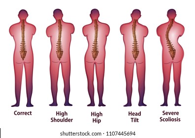 Human spine posture Back view