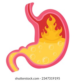 Dolor de estómago humano problemas digestivos. Enfermedad de Reflux Gastresofágico