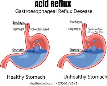 The human stomach is full of stomach acid. Acid reflux or gastroesophageal reflux, Heartburn. Stomach disease, stomach problem disease concept. Vector drawing