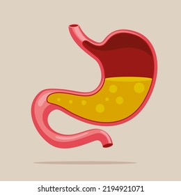 Human Stomach Full Of Gastric Acid, Cut View. Gastroesophageal Reflux Disease. Vector Illustration. 