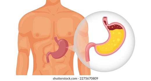 Human stomach full of gastric juice in body. Vector illustration isolated on white background. Cartoon style
