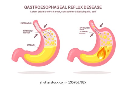 Human Stomach. Gastroesophageal Reflux Disease. GERD, Heartburn, Gastric Infographic. Acid Moving Up Into The Esophagus. Vector Flat Design