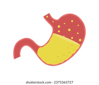 Human stomach. Gastroesophageal reflux disease