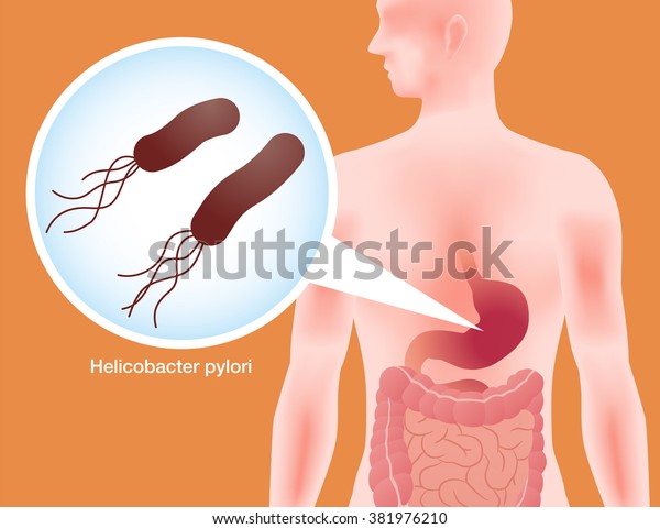 Stock Vektor Human Stomach Helicobacter Pylori Stomach Ache Bez Autorskych Poplatku 381976210