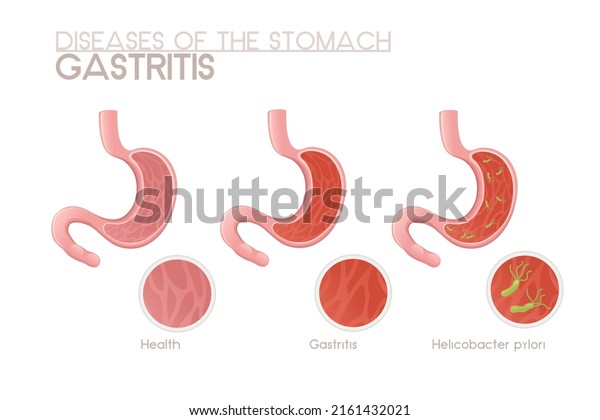 1,549 Gastritis Cartoon Images, Stock Photos & Vectors | Shutterstock