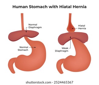 Estômago Humano Com Hérnia Do Hiato Diafragma Normal Estômago Normal Diafragma Fraco Hérnia Do Hiato