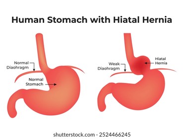 Estômago Humano Com Hérnia Do Hiato Diafragma Normal Estômago Normal Diafragma Fraco Hérnia Do Hiato