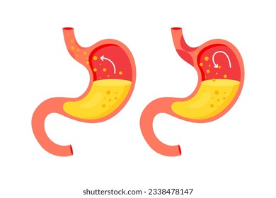 Human stomach. Organ of internal digestion system. Gastroesophageal reflux disease concept. Stomach with GERD and healthy one. Vector illustration in flat style