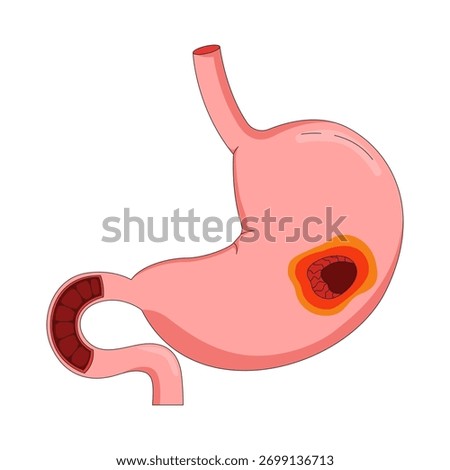 Human stomach with peptic ulcer 2D vector illustration. Anatomical organ inflammation. Digestive disease. Gastrointestinal tract wound flat object isolated on white background. Colorful cartoon image