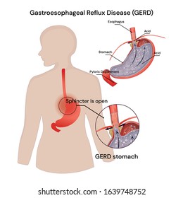 Human stomach in problem area have acid back up into esophagus which is cause gastroesophageal reflux disease. Mechanism of heartburn. 

