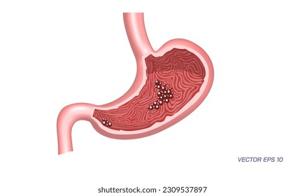 Problemas de estómago humano, enfermedades gastrointestinales. Trastornos Digestivos Frecuentes. Malas condiciones digestivas. Qué medicación correcta mantiene tu estómago sano. La biología estudiantil estudia imágenes materiales.