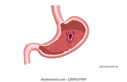 Human stomach problems, Gastrointestinal diseases. Common Digestive Disorders. Poor Digestive conditions. How right medication keep your stomach healthy. Student biology study material images.