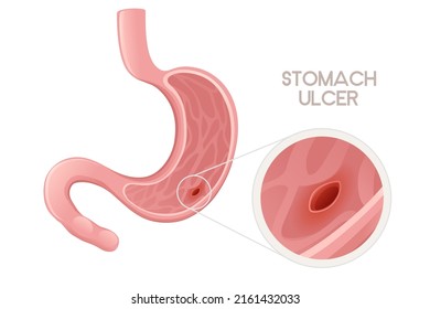 Human Stomach Ulcer Cartoon Design Human Anatomy Organ Vector Illustration On White Background