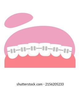 Human teeth with bracers. Orthodontic system on teeth. Dentist system. Vector illustration. 