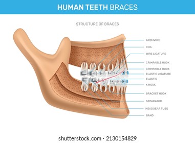 Human teeth braces infographics scheme with detailed description of structure realistic vector illustration