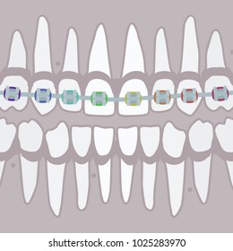 Human teeth with braces  - vector illustration