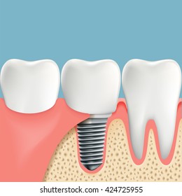 Human teeth and Dental implant. Anatomy of the oral cavity. Stock vector illustration.