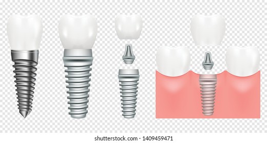 Human teeth and dental implant cut scheme, vector illustration. Dental implant structure with all parts crown, abutment, screw. medical pictorial. Vector illustration