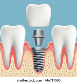 Human teeth and dental implant cut scheme. Stock vector illustration.