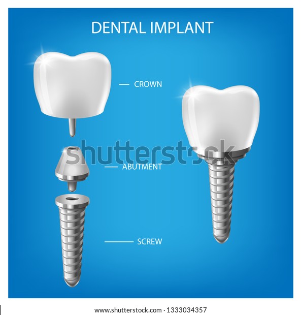 人間の歯と歯のインプラントの切断スキーム ベクターイラスト すべてのパーツを含む歯科用インプラント構造 クラウン アバットメント ねじ 医学絵 のベクター画像素材 ロイヤリティフリー