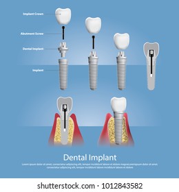 Human teeth and Dental implant Vector Illustration