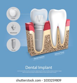 Human Teeth And Dental Implant Vector Illustration