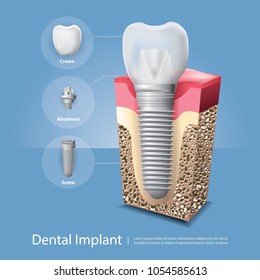 Human teeth and Dental implant Vector Illustration