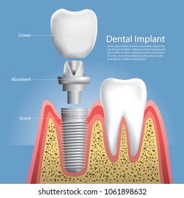 Human teeth and Dental implant Vector Illustration